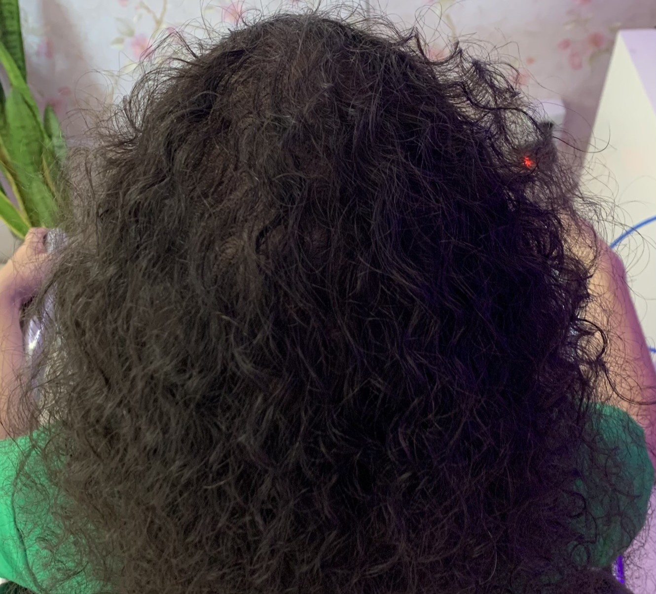 Guia Alopecia Androgenética Feminina