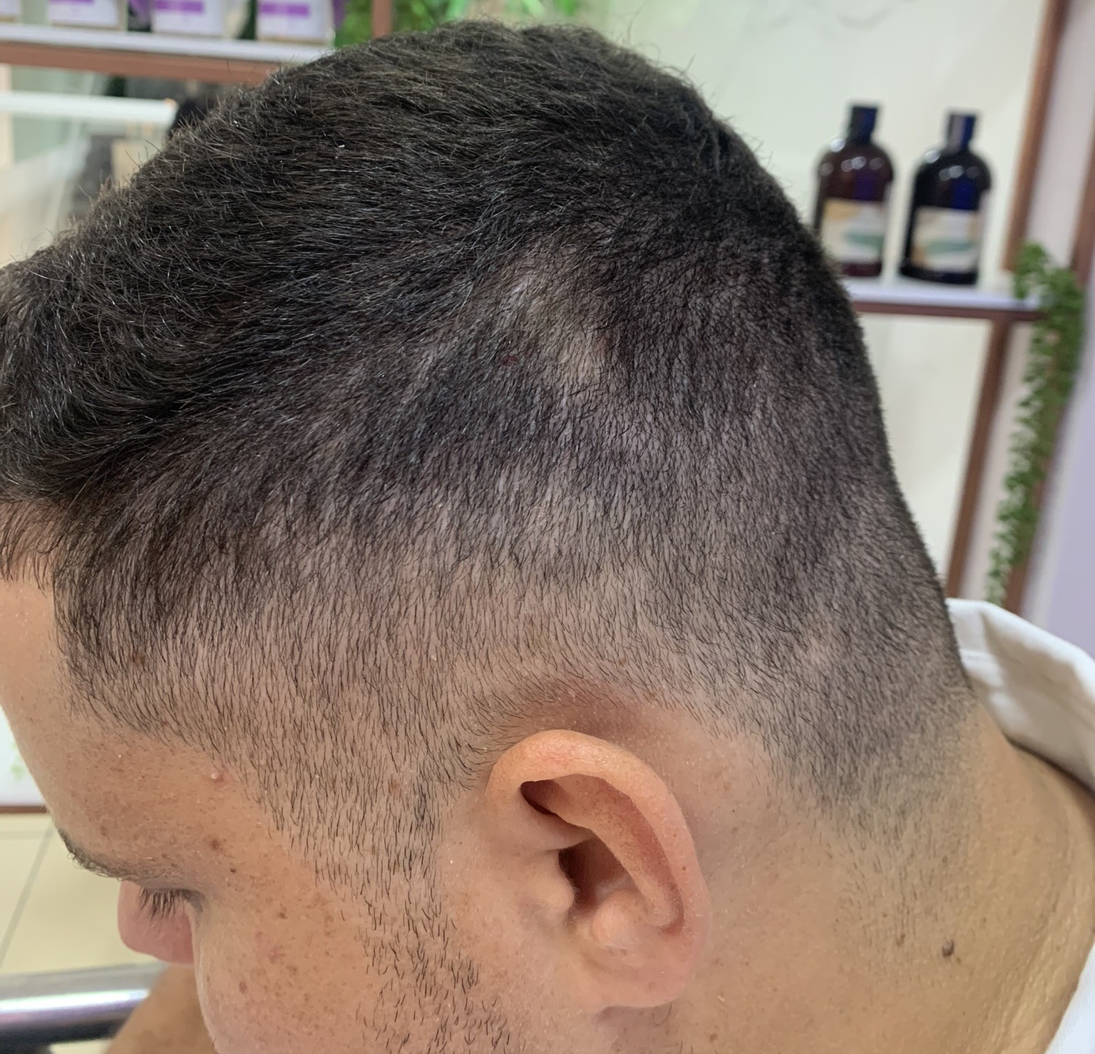 Guia Alopecia Areata